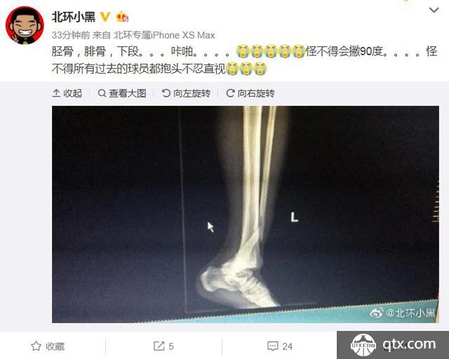 河南建业杨阔重伤 登巴巴式断腿重现 胆小勿入