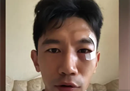 大连队队员朱婷谈到了这次受伤:他的眼睑和眉骨受伤，视力也几乎受损。